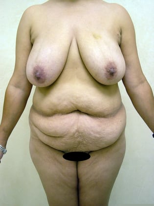 Breast Lift before and after - before