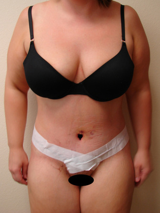 Abdominoplasty before and after - after