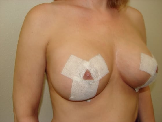 Breast Lift before and after - after