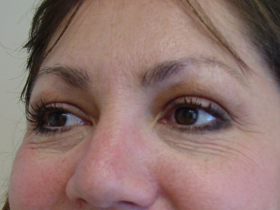 Blepharoplasty before and after - after