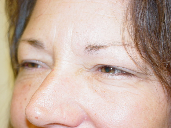 Blepharoplasty before and after - before