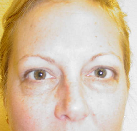 Blepharoplasty before and after - before