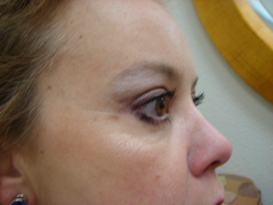 Blepharoplasty before and after - after