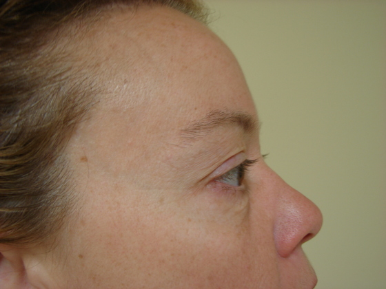 Blepharoplasty before and after - before