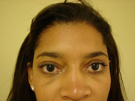 Blepharoplasty before and after - after