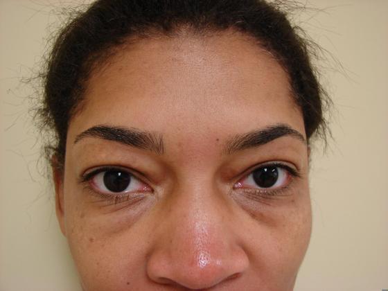 Blepharoplasty before and after - before