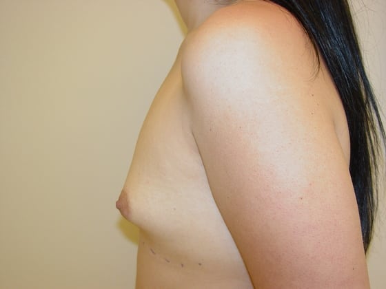 Breast Augmentation before and after - before