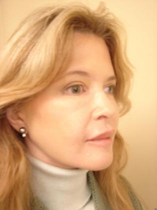 Blepharoplasty before and after - after