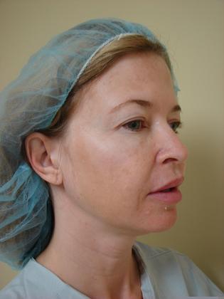 Blepharoplasty before and after - before