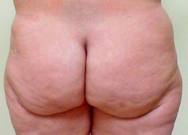 Brazilian Butt Lift before and after - before