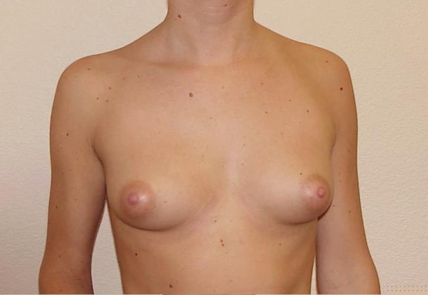 Breast Implants before and after - before
