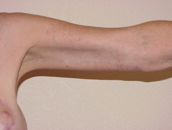 Arm Lift before and after - after