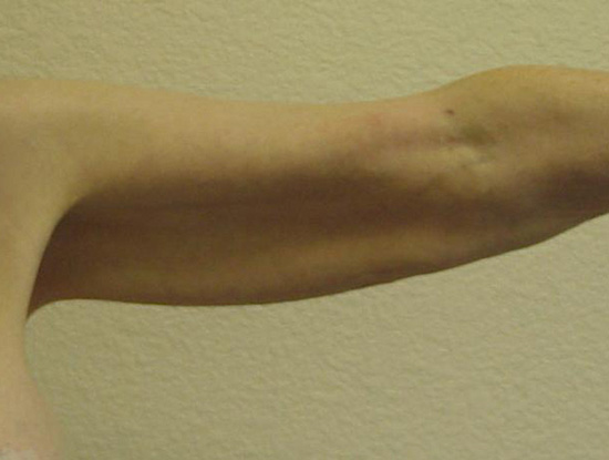 Arm Lift before and after - before