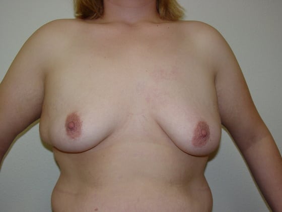 Breast Augmentation before and after - before