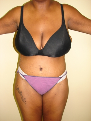 Abdominoplasty before and after - after