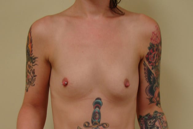 Breast Augmentation before and after - before