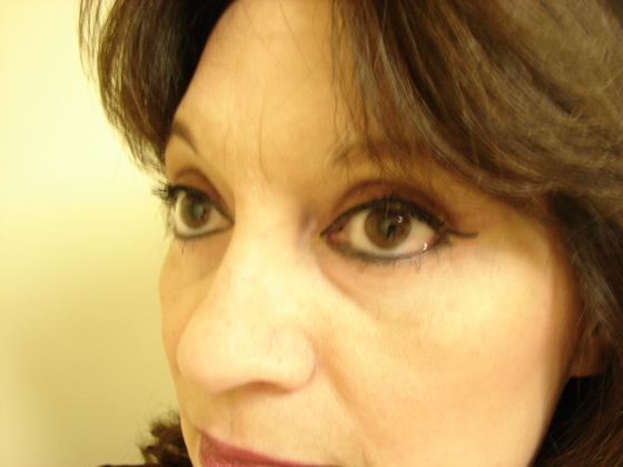 Blepharoplasty before and after - after