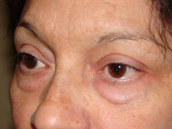 Blepharoplasty before and after - before