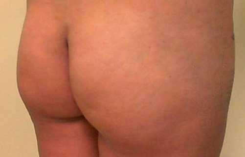 Brazilian Butt Lift before and after - before