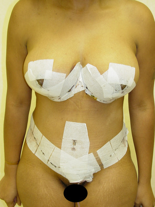 Abdominoplasty before and after - after