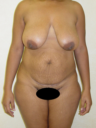 Abdominoplasty before and after - before