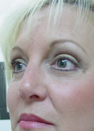Blepharoplasty before and after - after
