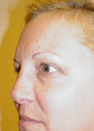 Blepharoplasty before and after - before
