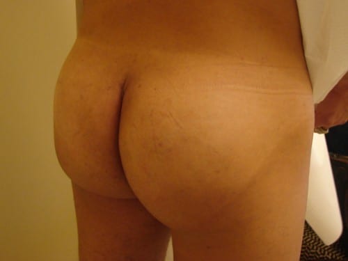 Brazilian Butt Lift before and after - after