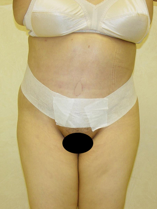 Abdominoplasty before and after - after