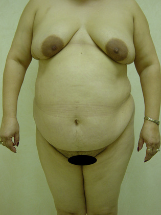 Abdominoplasty before and after - before