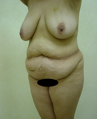 Abdominoplasty before and after - before