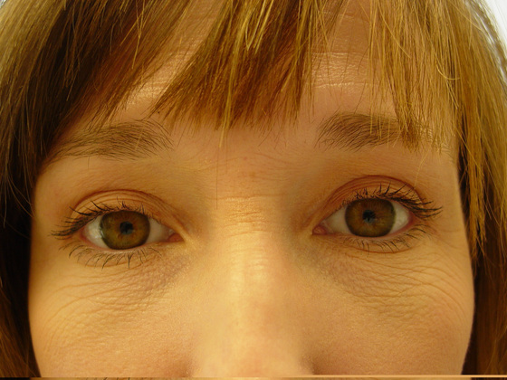 Blepharoplasty before and after - after