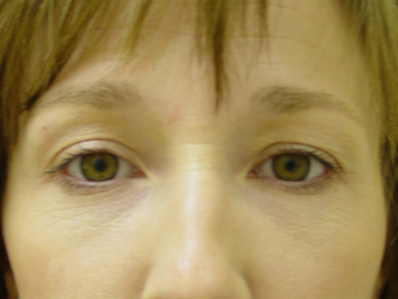 Blepharoplasty before and after - before