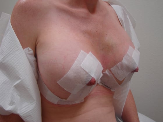 Breast Lift before and after - after