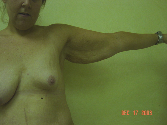 Arm Lift before and after - before