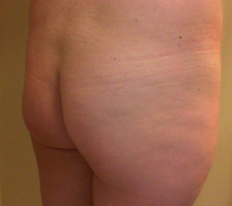 Brazilian Butt Lift before and after - before