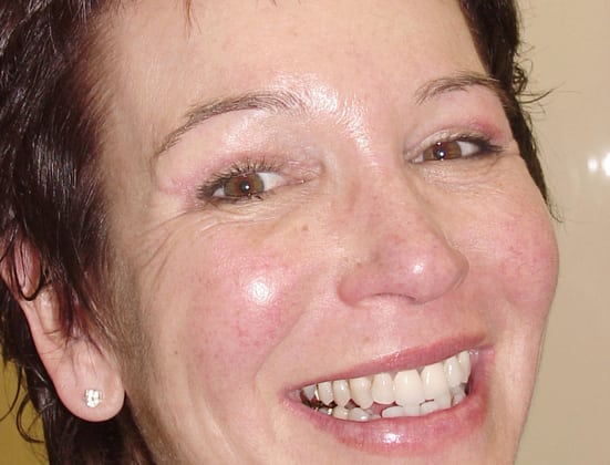 Blepharoplasty before and after - after