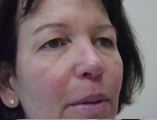 Blepharoplasty before and after - before