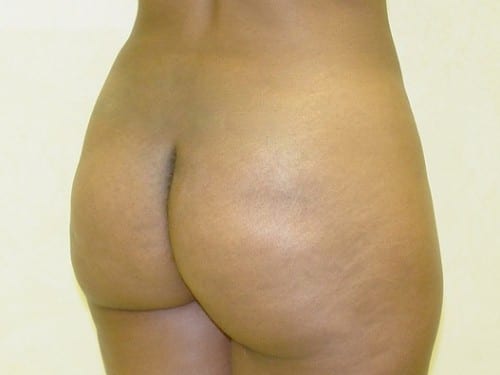 Brazilian Butt Lift before and after - after
