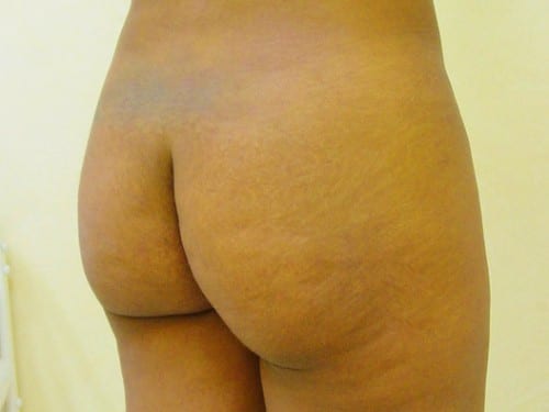 Brazilian Butt Lift before and after - before