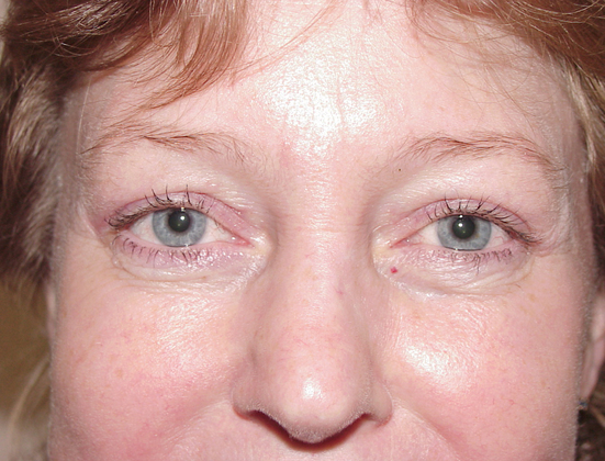 Blepharoplasty before and after - after
