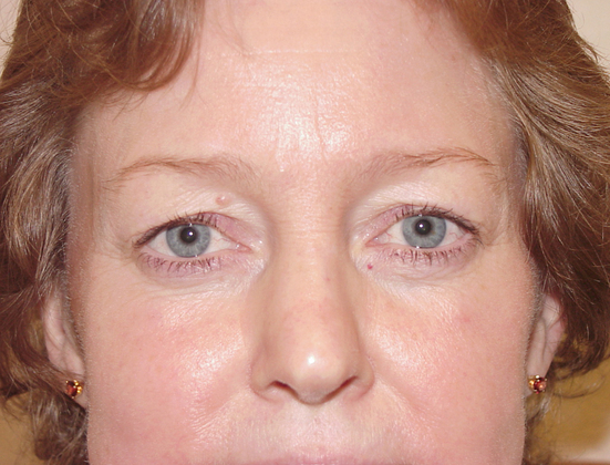 Blepharoplasty before and after - before