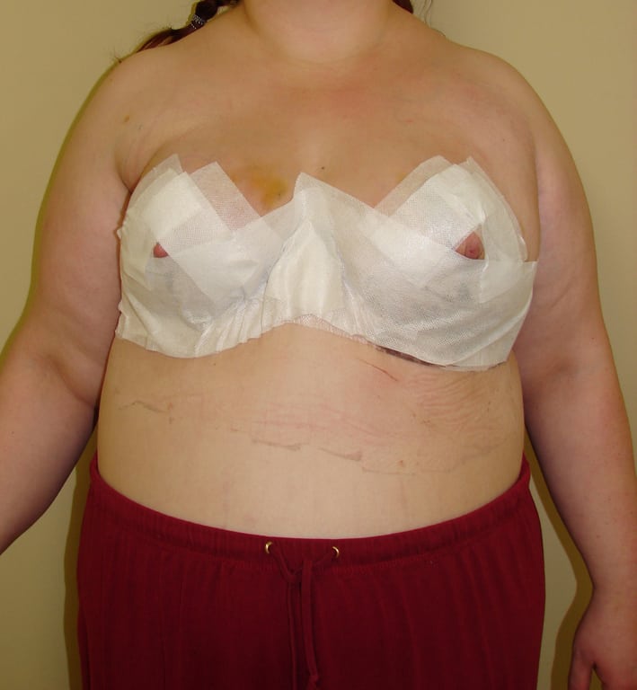 Breast Reduction before and after - after