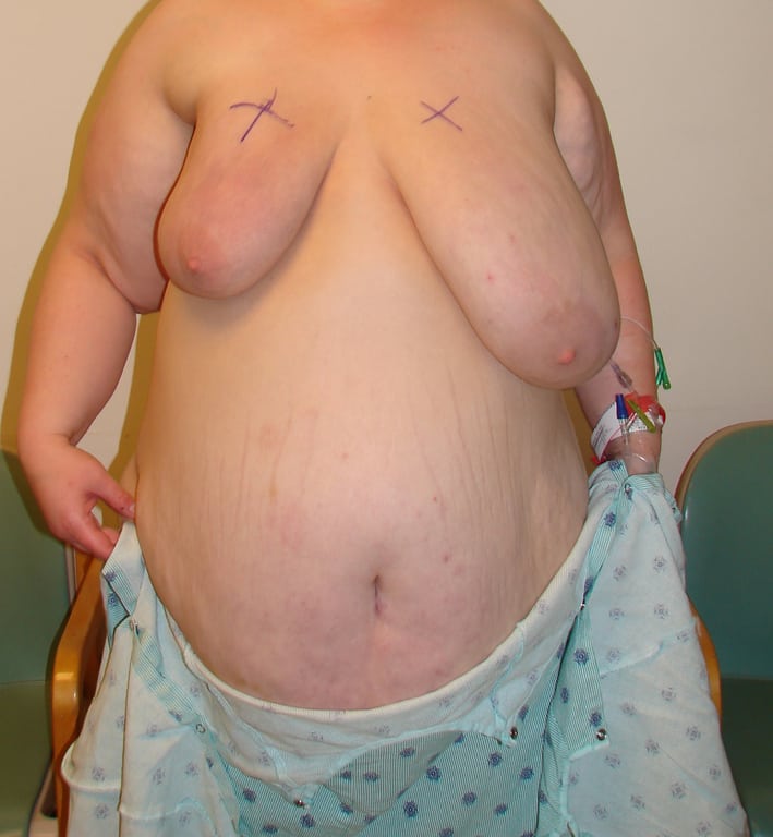 Breast Reduction before and after - before