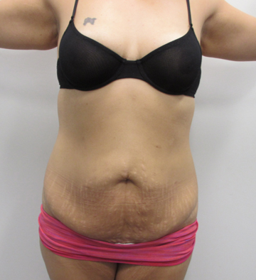 Tummy Tuck before — Dr. Lawrence Lin