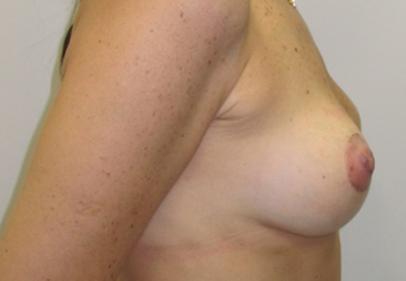 Breast Lift after — Dr. Lawrence Lin