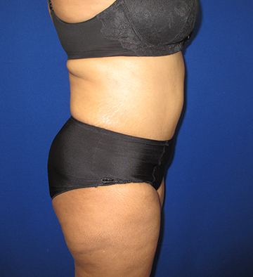 Tummy Tuck before and after - after
