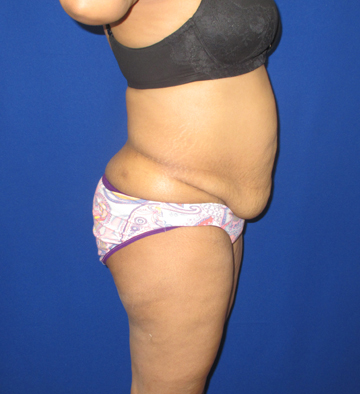 Tummy Tuck before and after - before
