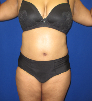 Tummy Tuck before and after - after