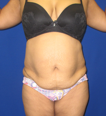 Tummy Tuck before and after - before